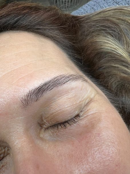 Referenzbild Referenzbild, Frau, Augenbrauenlifting, Browlifting