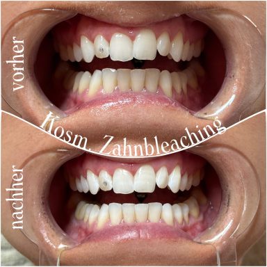 Referenzbild Referenzbild, kosmetisches Zahnbleaching, Frau 30 Minuten.