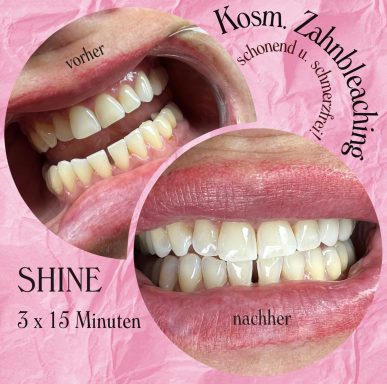 Referenzbild Referenzbild, kosmetisches Zahnbleaching, Frau nach 45 Minuten Behandlung