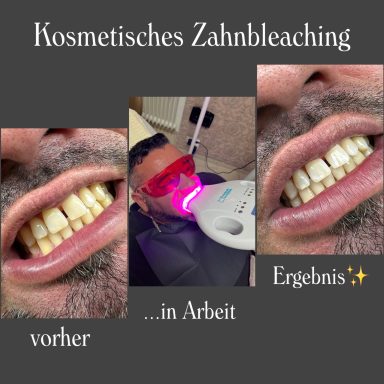 Referenzbild Testemonial-Fotoserie, kosmetisches Zahnbleaching Mann, vorher, Behandlung, Nachher.