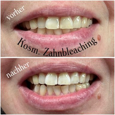 Referenzbild Referenzbild, kosmetisches Zahnbleaching, Frau nach 45 Minuten Behandlung.