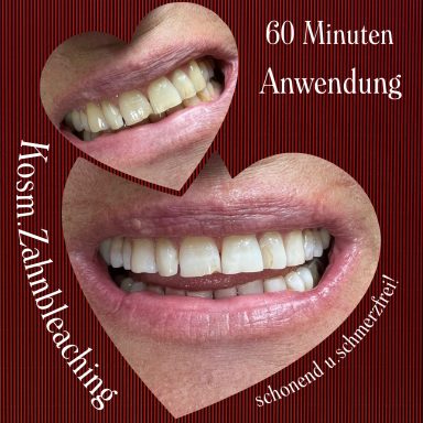 Referenzbild Testemonial-Foto, kosmetisches Zahnbleaching, Frau nach 60 Minuten Behandlung.
