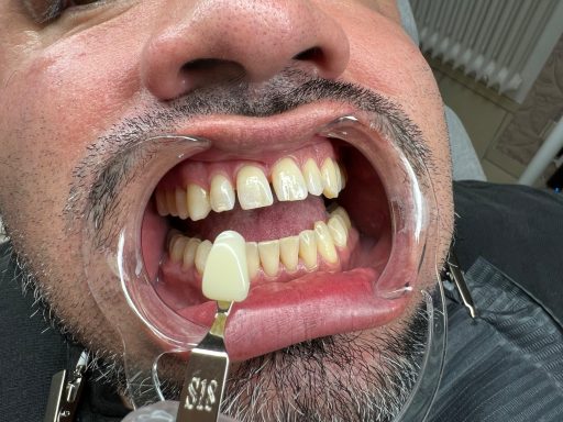 Referenzbild Farbanalyse kosmetisches Zahnbleaching, Mann