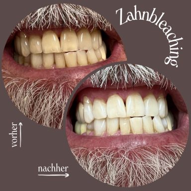 Referenzbild Testemonial-Foto, kosmetisches Zahnbleaching, Mann nach 60 Minuten Behandlung